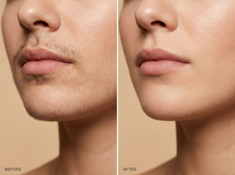Before and after: coarse hormonal facial hair removed