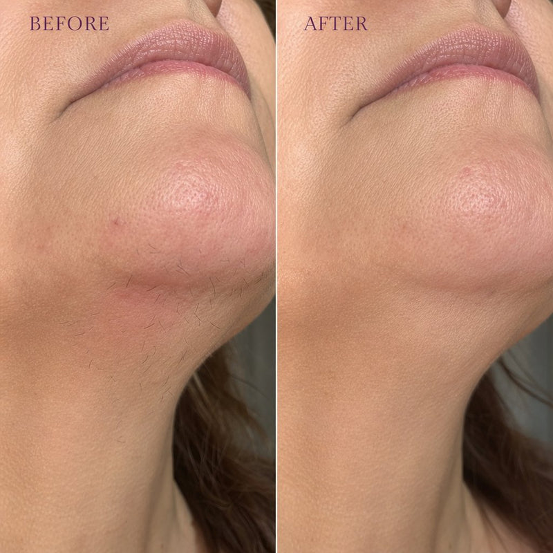Before and after on the chin