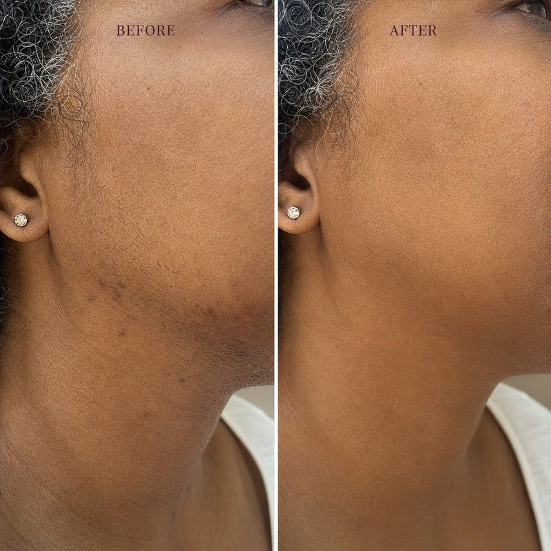 Before and after on the jawline