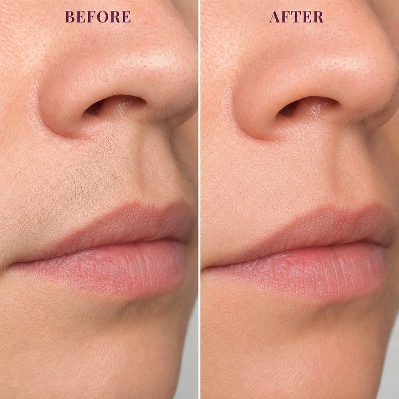 Before and after on the upper lip
