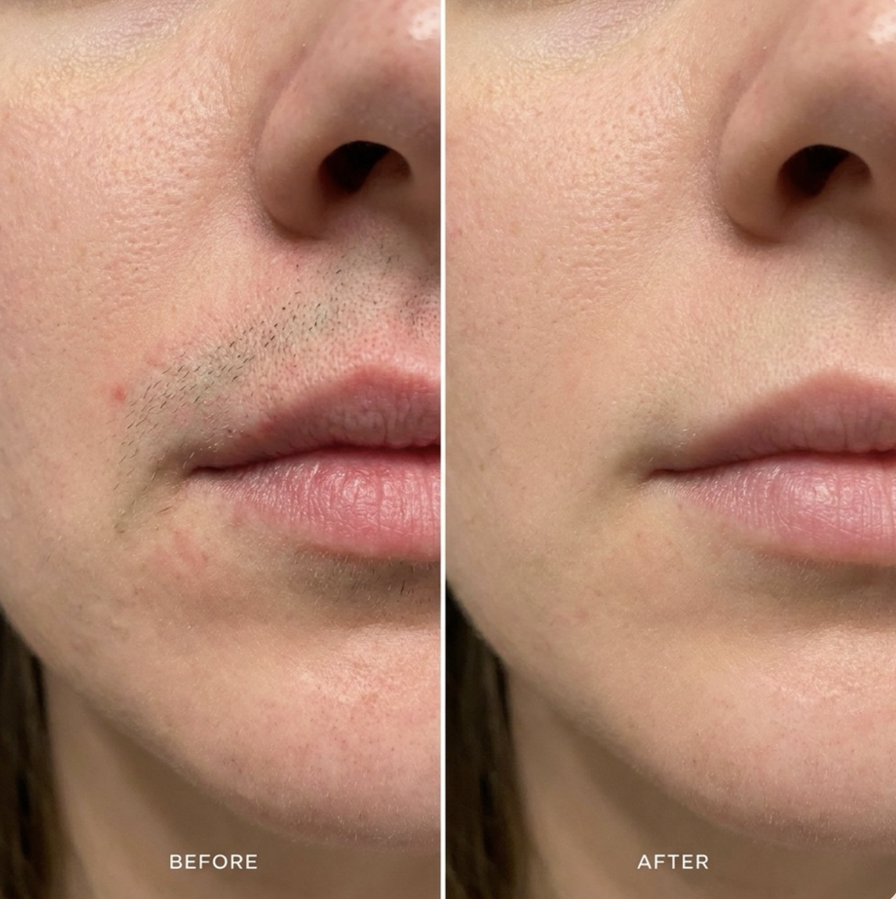 Before and after Meravae showing visible facial hair removed
