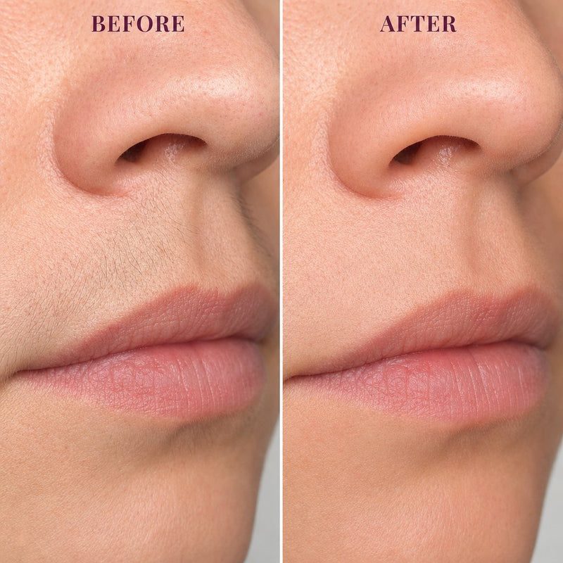 Before and after on the upper lip