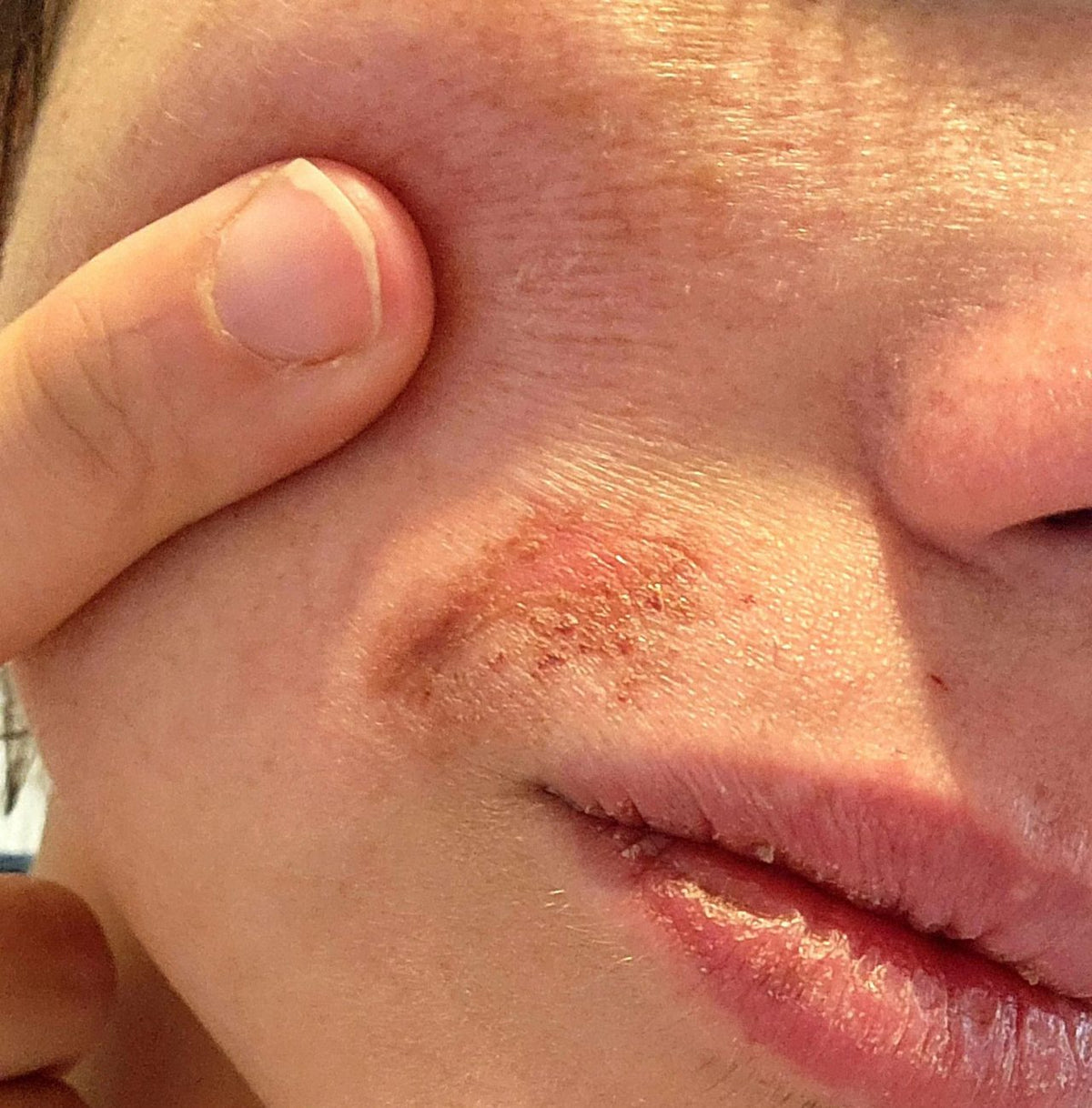 User-supplied close-up photo of redness above the upper lip